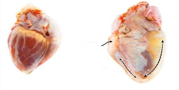 a healthy heart and a heart affected by alcohol
