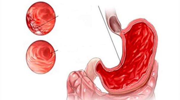damage to the gastric mucosa when drinking alcohol