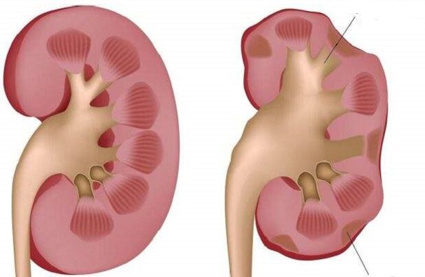 healthy and sick kidney when drinking alcohol